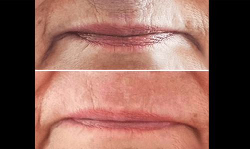non Surgical Wrinkle Removal Plasma IQ Before After Mississauga Oakville